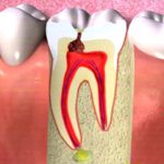 Caries – Interproximal