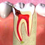 Caries – Oclusal