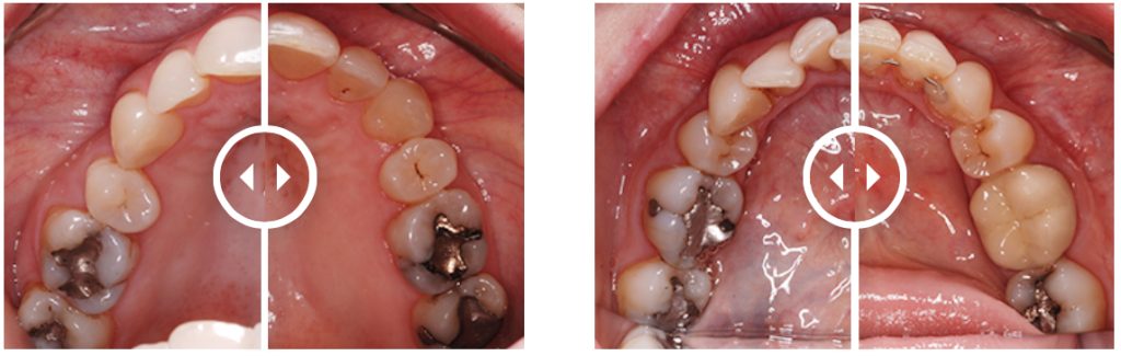 Orthodontic Aligners treatment before and after. Treatment time: 7 months