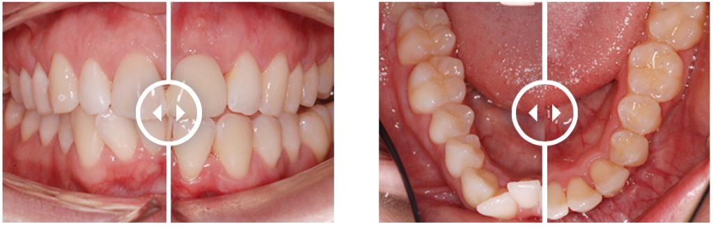 Orthodontic Aligners treatment before and after. Treatment time: 9 months